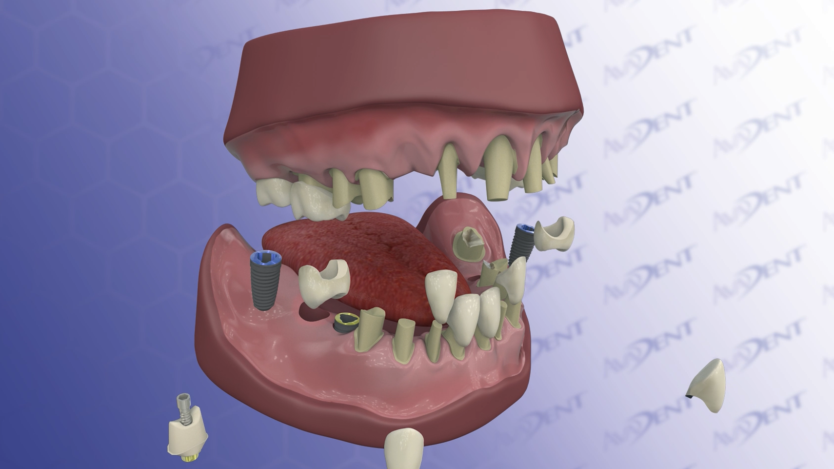 Full Mouth Reconstruction