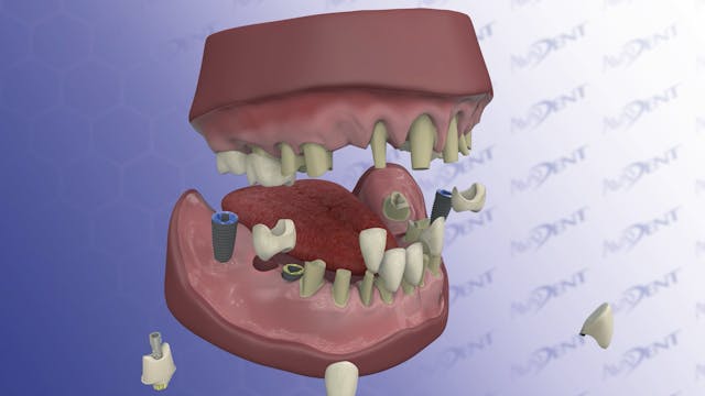 Full Mouth Reconstruction