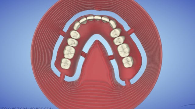 AvaMax Denture Ti-Spacetruss Frame