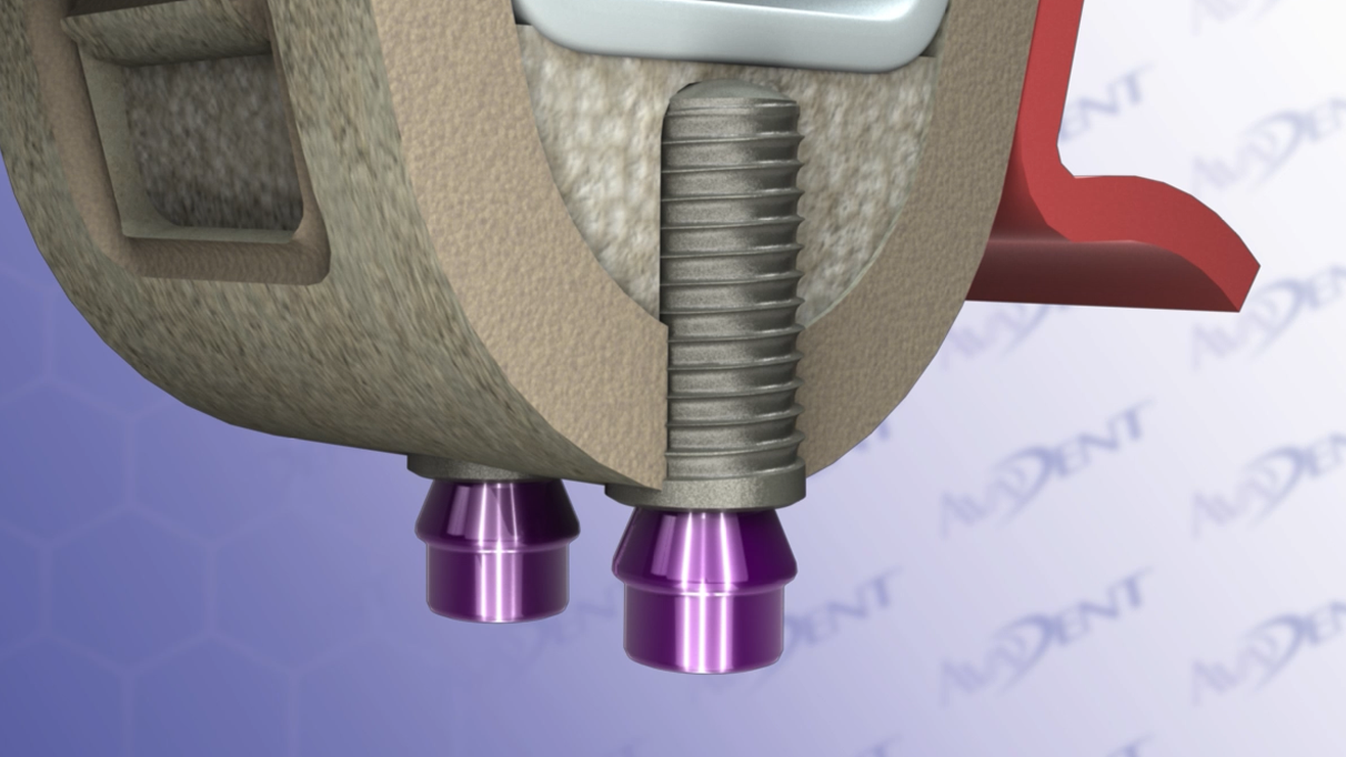 Sinus Lift with Lateral Approach