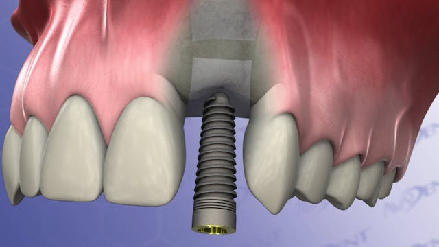 Single Implant Placement - Lateral In...