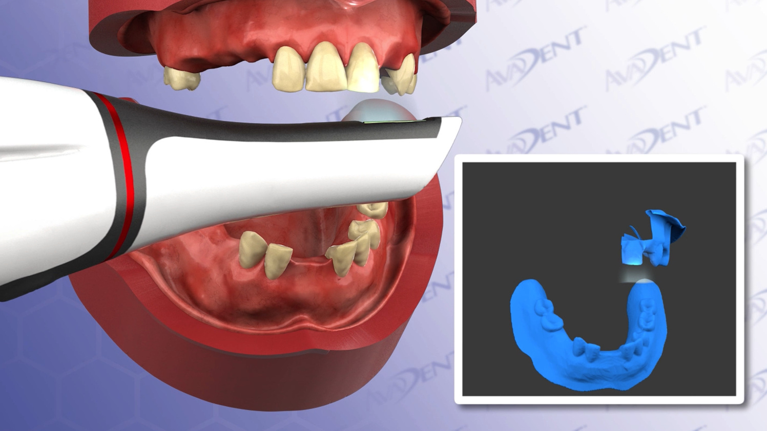 Intraoral Scanning for Immediate Denture Protocol