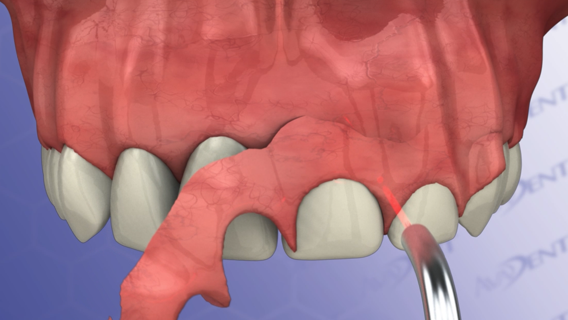 Gingivectomy with Scalpel