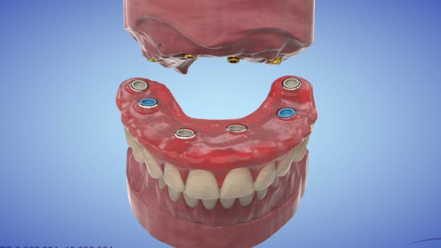 AvaMax Hybrid Prosthesis with LOCATOR...