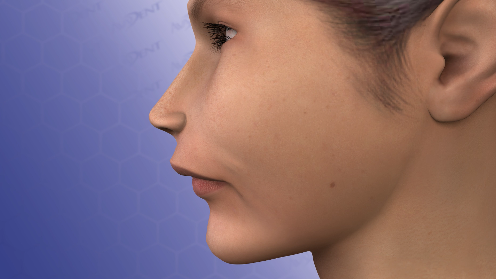 Class II Surgical Correction