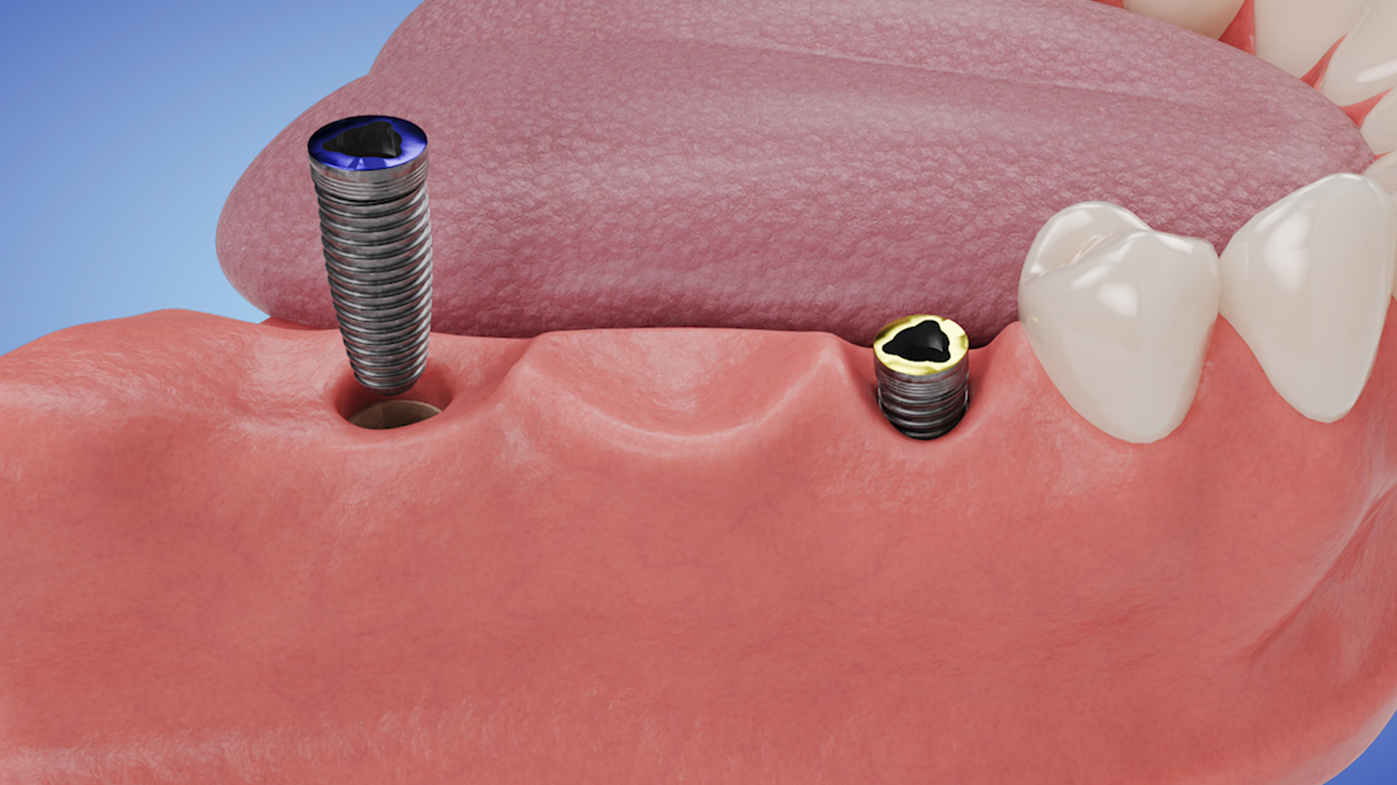 Implant Supported Three-Unit Bridge