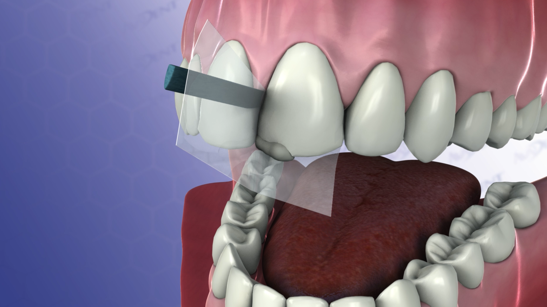 Anterior Bonding Class IV