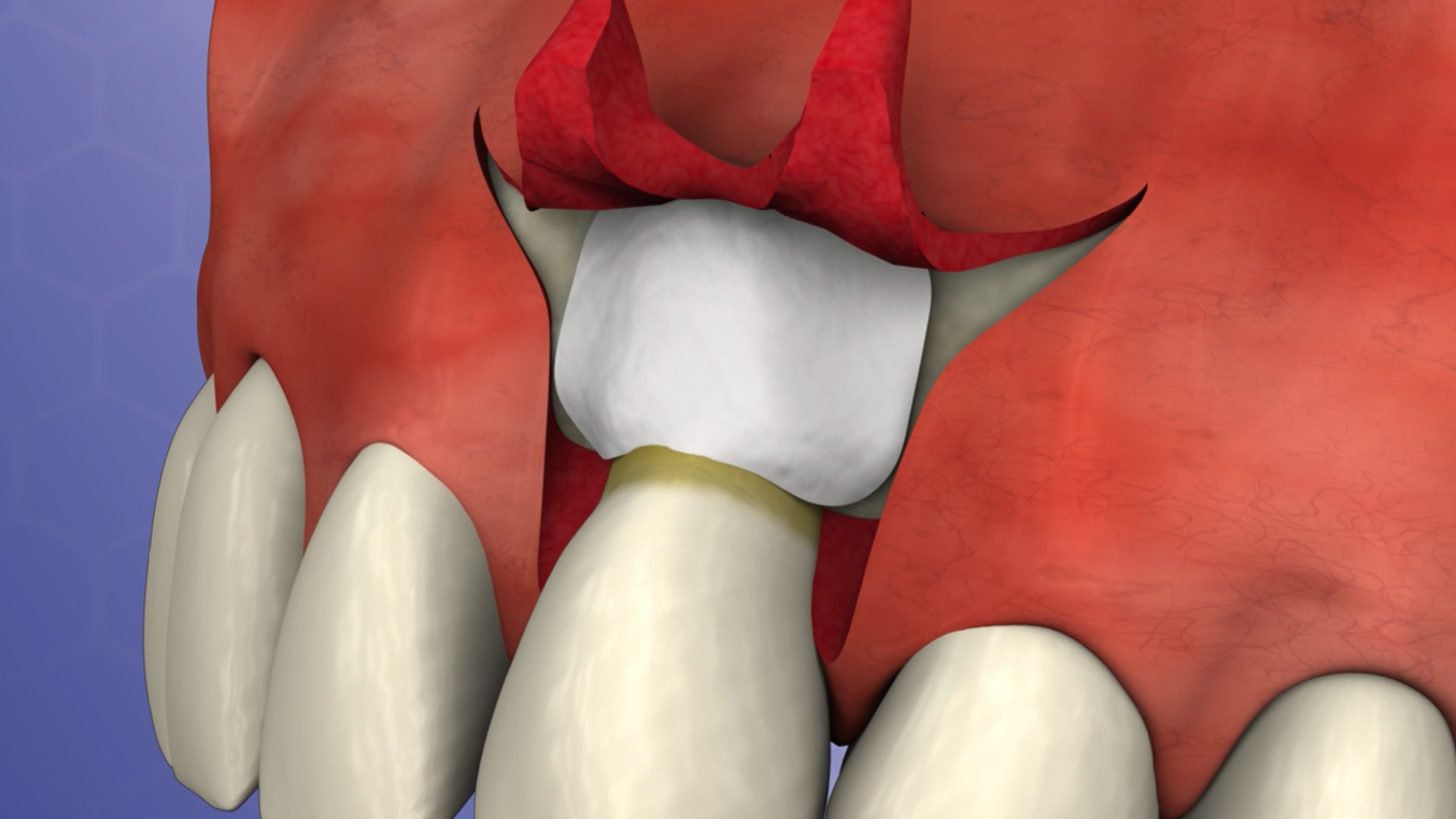 Root Coverage with Alloderm™