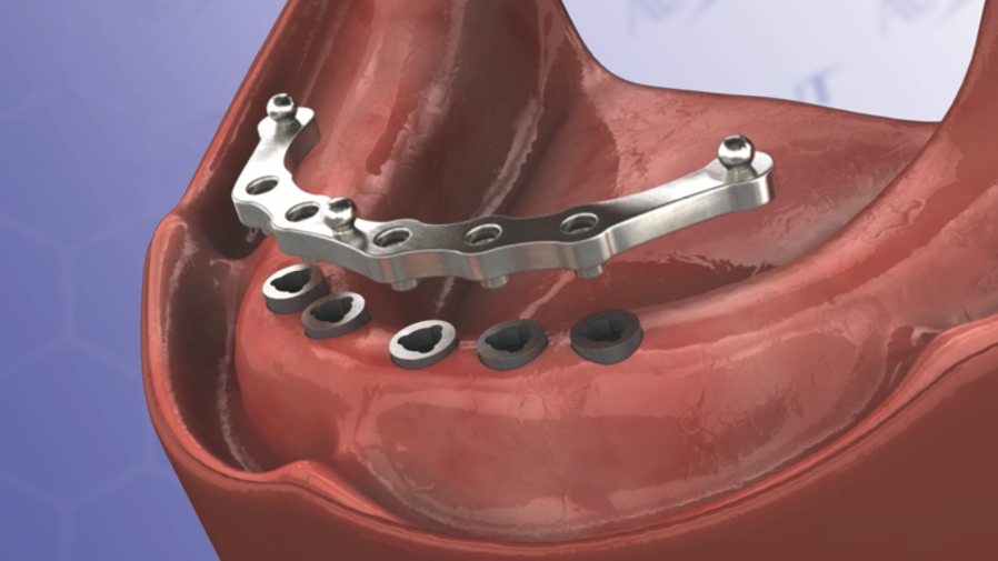 Milled Bar Procedure