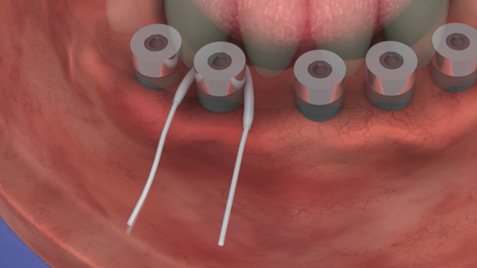 Cleaning a Fixed-Detachable with Super Floss
