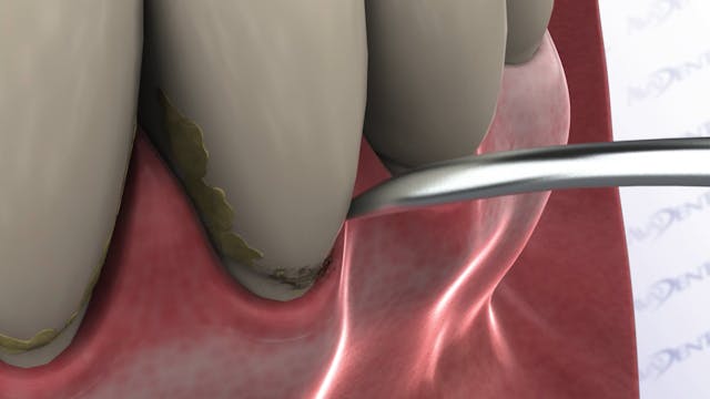 Ultrasonic Scaling