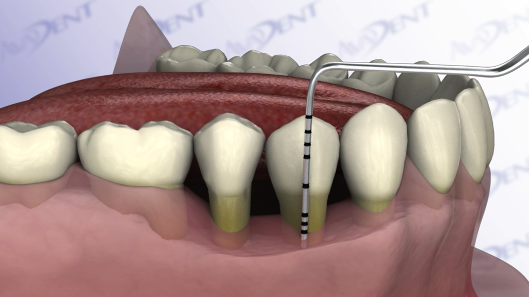 Pocket Reduction Procedure