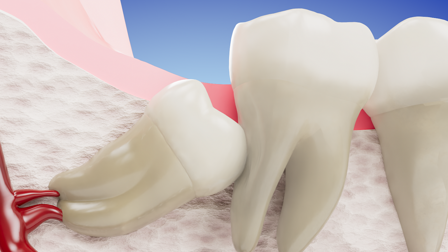 Impacted Third Molar - Crowding and Damage