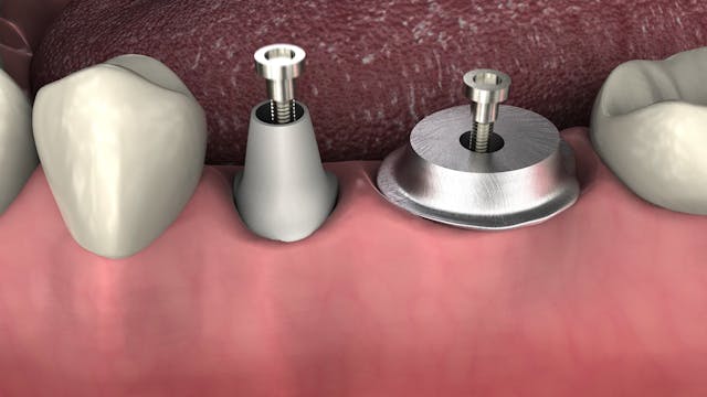 Ceramic vs Metal Crowns with Implants