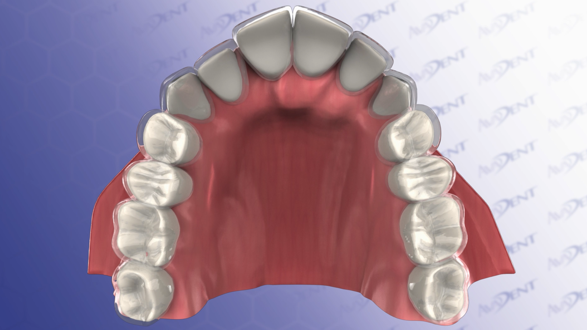 Orthodontic Aligners