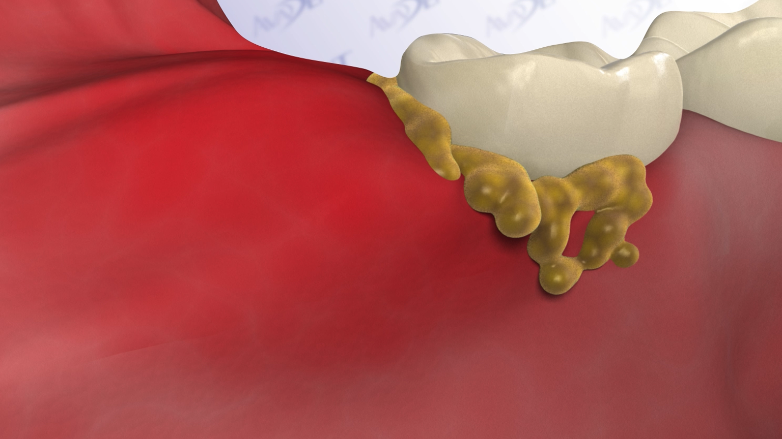 Impacted Third Molar - Infected from Bacteria