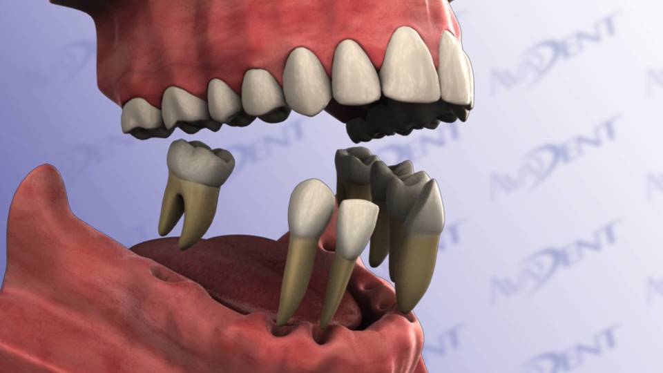 Immediate Denture with Extractions