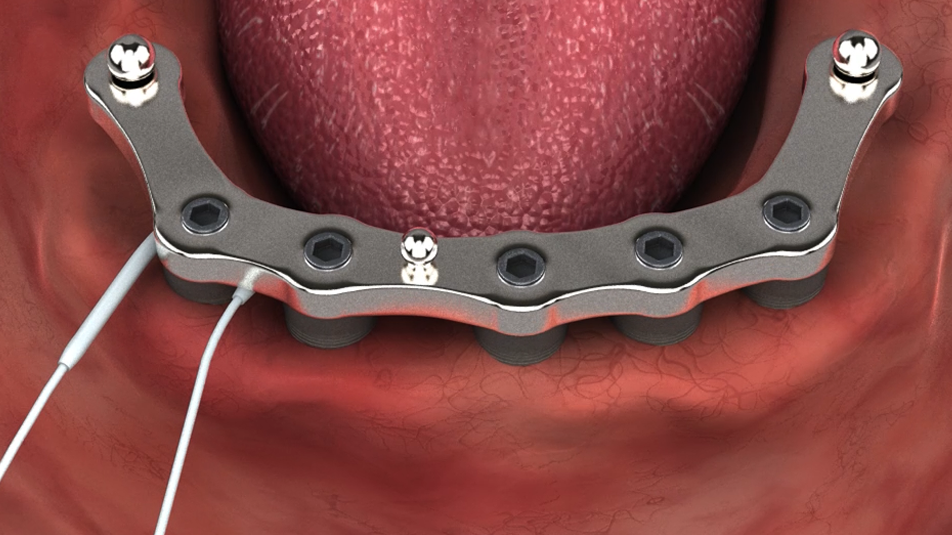 Cleaning Milled Bar using Super Floss