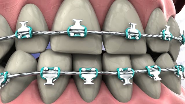 Correcting a Class III Malocclusion