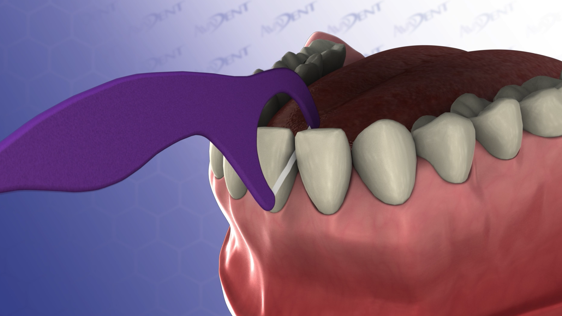 Flossing Technique with Assistant