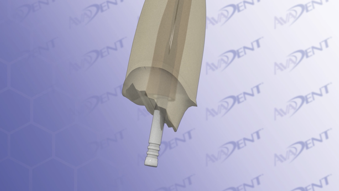 Esthetic Post and Core with Crown