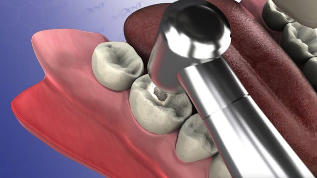 Filling A Cavity with White Filling M...