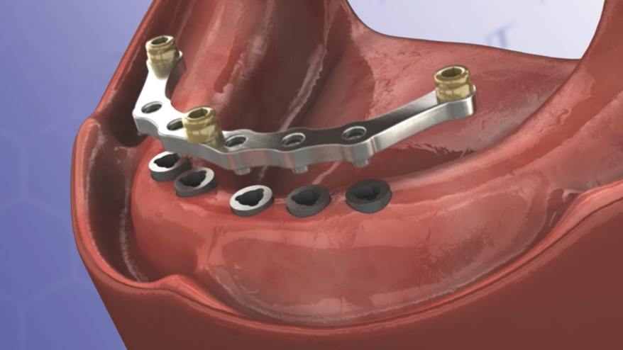 Milled Bar Procedure Using LOCATOR® Attachments