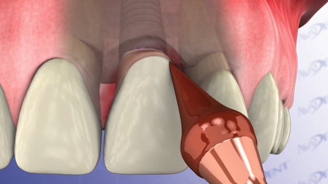 Peri-Implantitis
