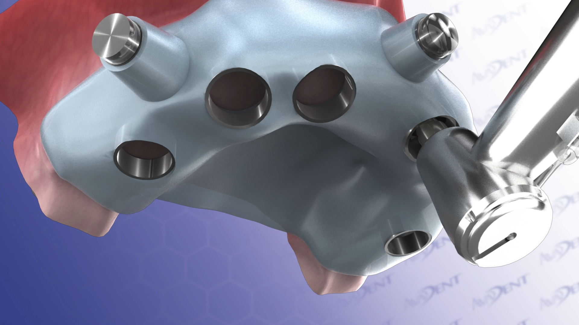 Upper Guided Fixed Detachable