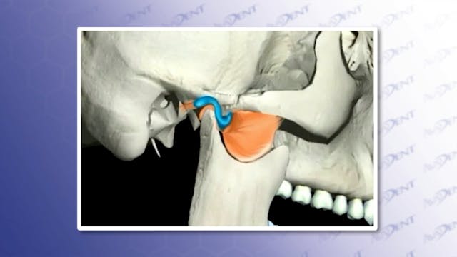 TMJ - Anterior Disc Displacement