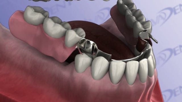 Removable Partial Denture