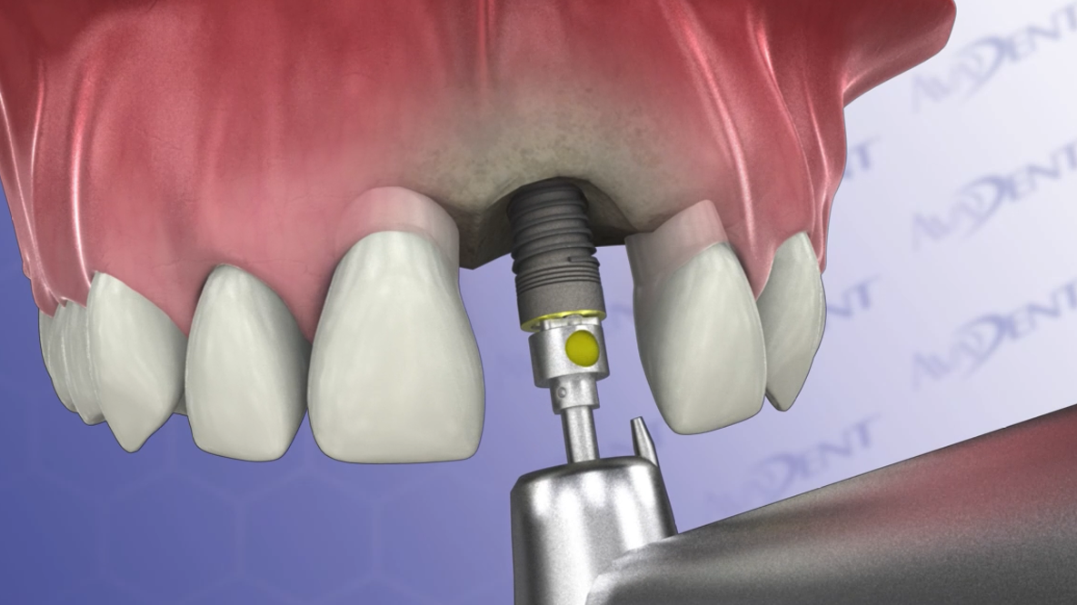 Single Tooth Two Stage Procedure - Upper Central Incisor