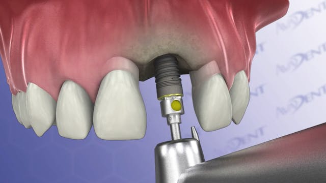 Single Tooth Two Stage Procedure - Up...