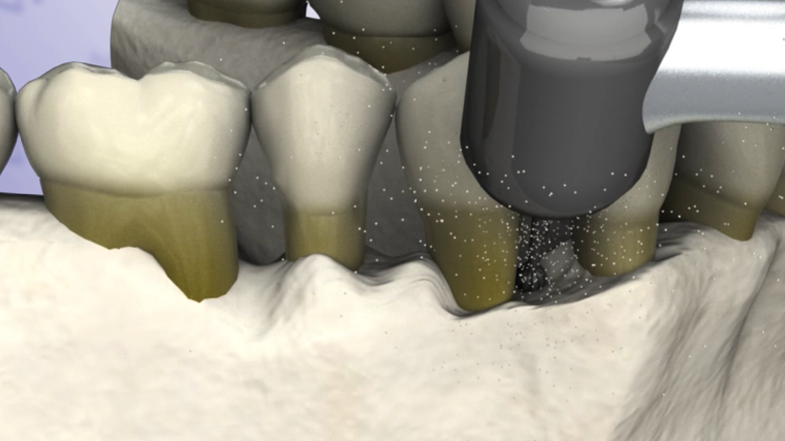 Pocket Reduction with Osteoplasty