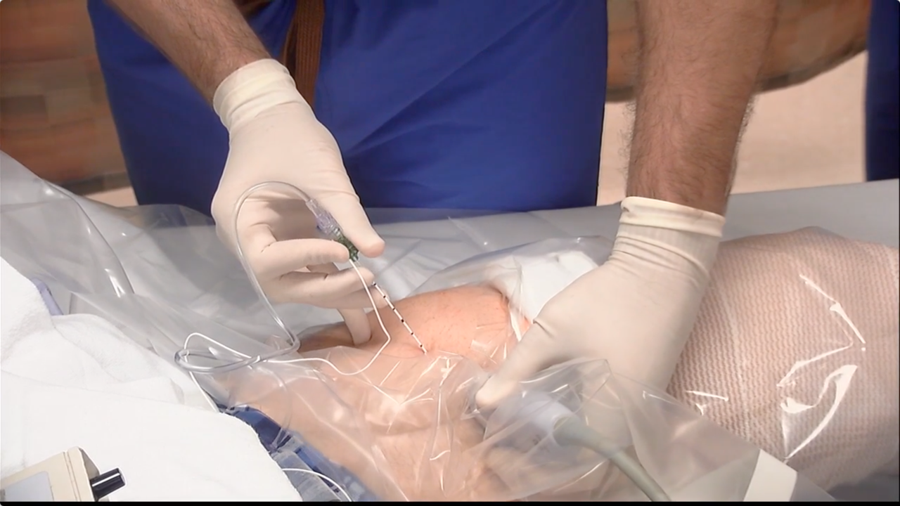 Bilateral Adductor Canal Catheters