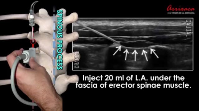 Erector Spinae Plane (ESP) Blocks - BLOCKJOCKS.COM