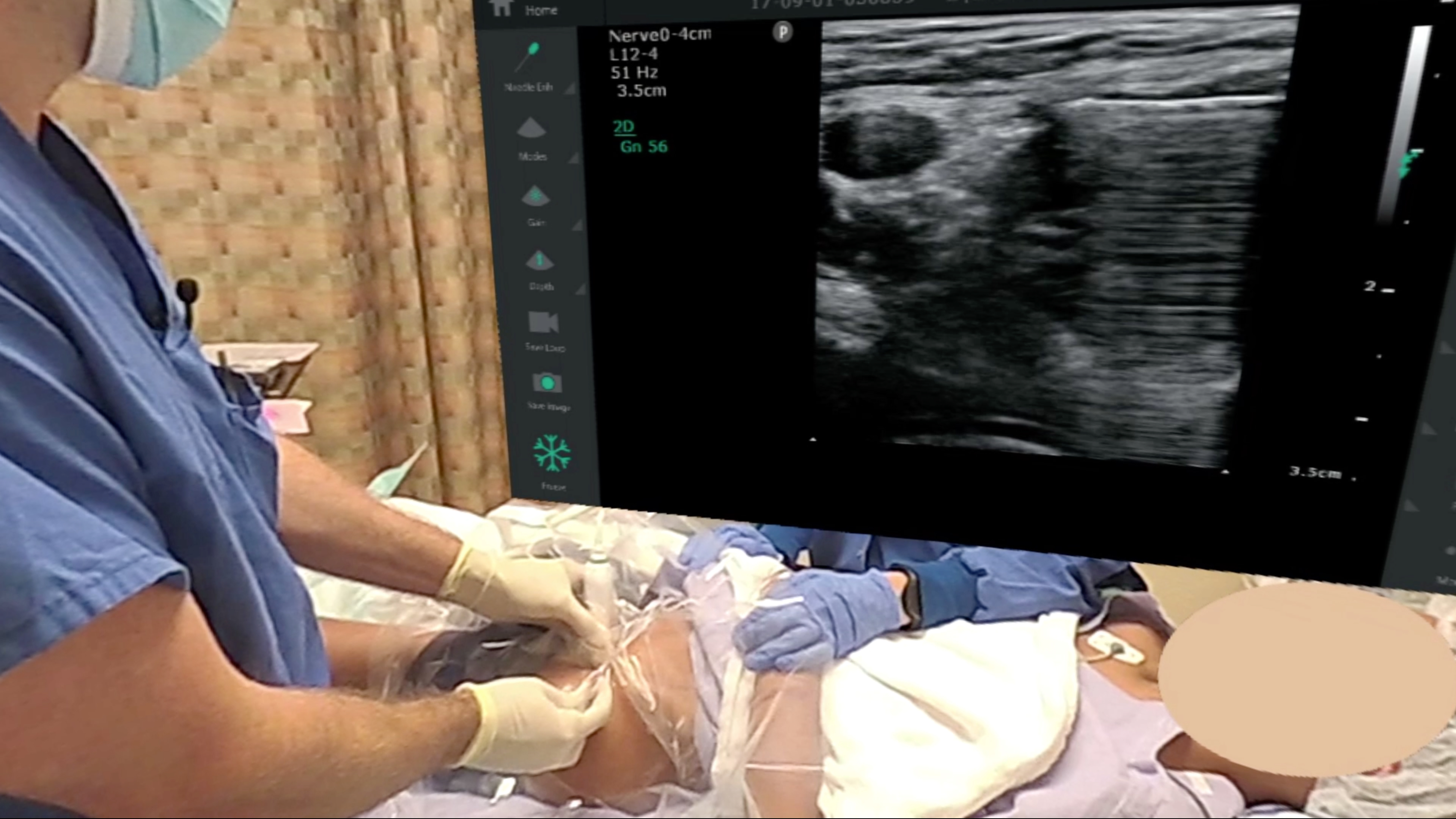 Femoral Cath in 360VR- Hyperframe Edition