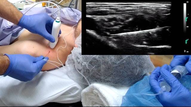 *NEW* Ultrasound-Guided Supraclavicular Block