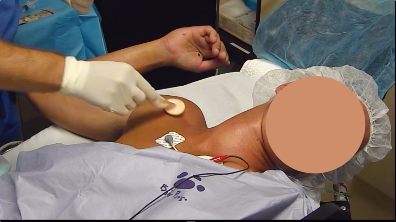 US-Guided Infraclavicular Catheter- Dealing with an Aberrant Vessel