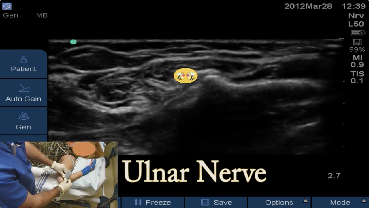 Ulnar Block at Elbow