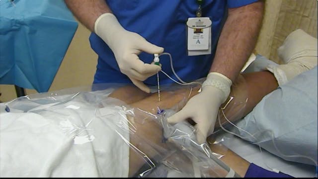 US-Guided Tunneled Popliteal Catheter