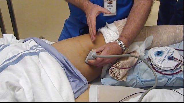 US-Guided Adductor Canal Catheter- Po...