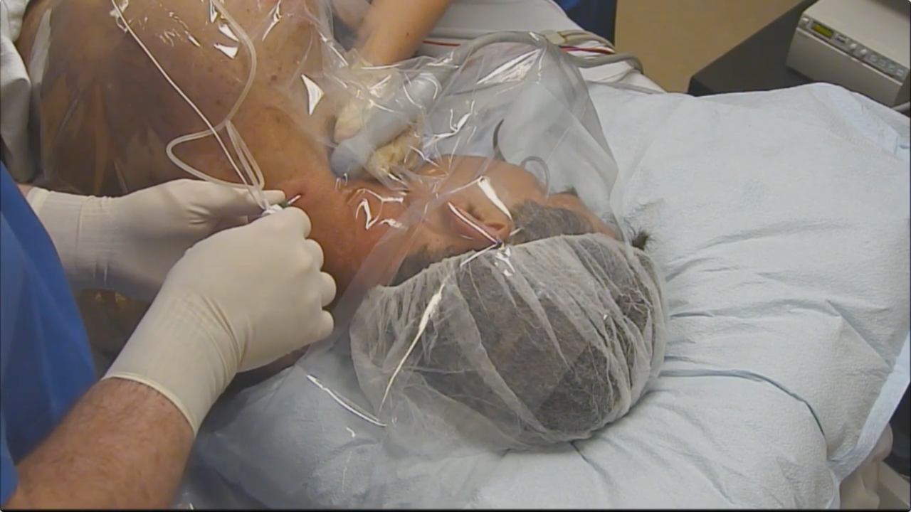 Posterior Interscalene Catheter