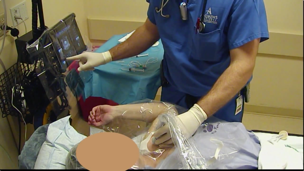 Infraclavicular Catheter