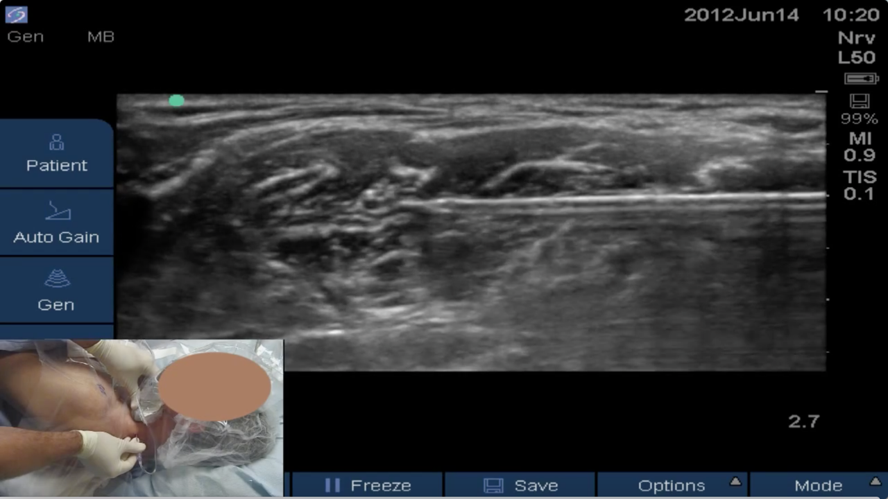 Styleted Interscalene Catheter