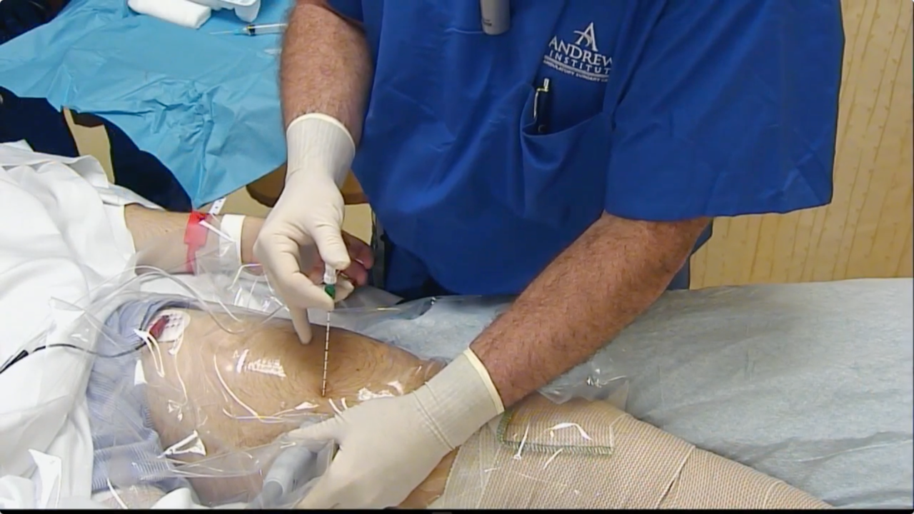 Tunneled Saphenous/Adductor Canal Catheter