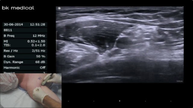 Axillary Virtual Ultrasound Workshop - Axillary - BLOCKJOCKS.COM