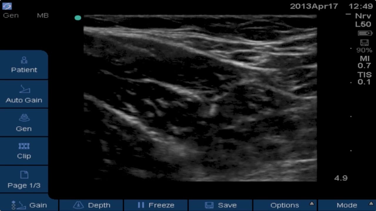 Obturator Nerve Block Ultrasound