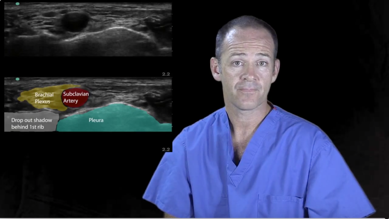 How to Perform an Ultrasound-Guided Supraclavicular Nerve Block