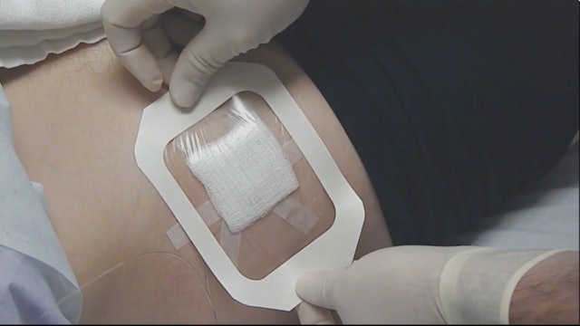 Femoral Catheter Dressing Placement with Histoacryl Skin Sealant